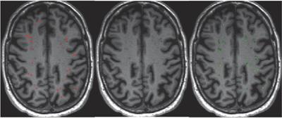 Perivascular spaces as a marker of disease severity and neurodegeneration in patients with behavioral variant frontotemporal dementia